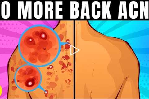 14 Ways To Get Rid Of Back Acne Once And For All