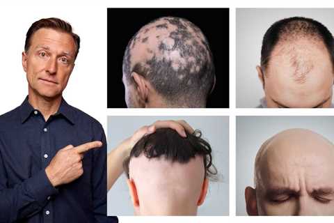 The 11 Types of Alopecia (AND HOW TO FIX IT) - Dr. Berg