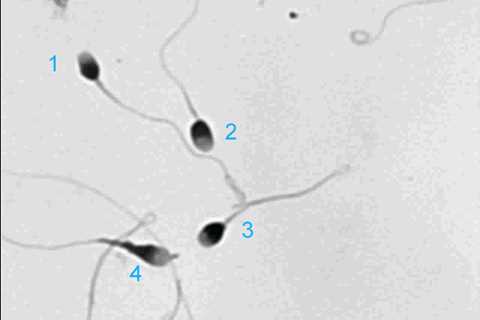 Head Defects in Sperm Percentage