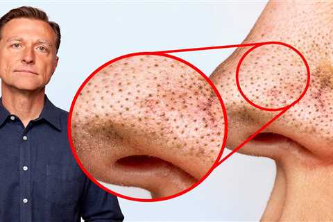Remove Blackheads PERMANENTLY Simply by Tweaking Your DIET