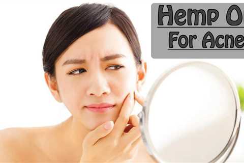 Hemp Oil For Acne Review | CBDhealinghand.com