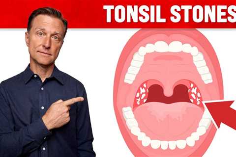 What CAUSES Tonsil Stones and How to Prevent Them