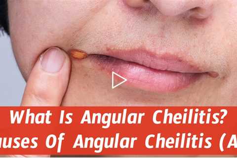 What Is Angular Cheilitis? Causes Of Angular Cheilitis (AC)
