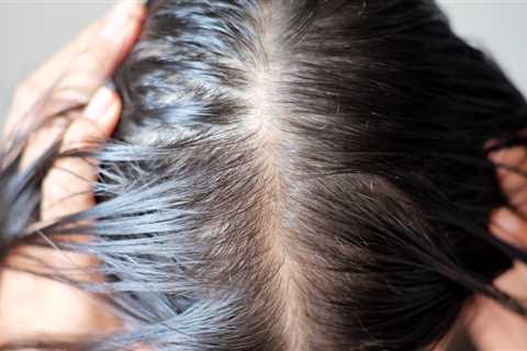 Eating Too Much of This Type of Food May Cause Hair Loss