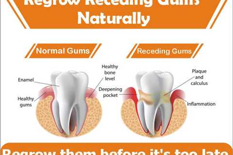 Reverse Receding Gums With Home Remedies - Music, Mind and Health