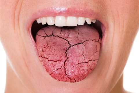 Cures For Dry Mouth - Body Health Solutions