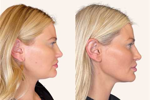 At Your Leisure Aesthetics: High End Private Lip Filler Services in Scottsdale Arizona Provides..