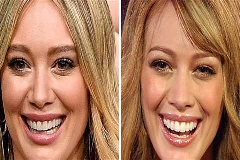 What dental procedures do celebrities use?
