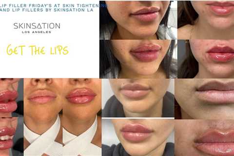 Lip Filler and Botox Fridays at our Medical spa in Los Angeles, California | Skin Tightening, Botox ..