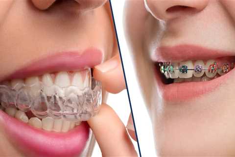 Do braces take longer than invisalign?