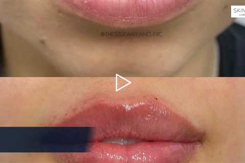 Where to get lip fillers Los Angeles