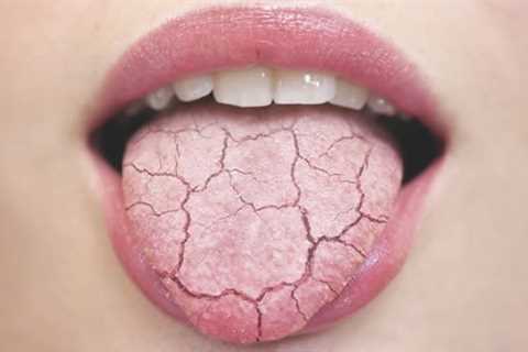 What causes dry mouth and white tongue