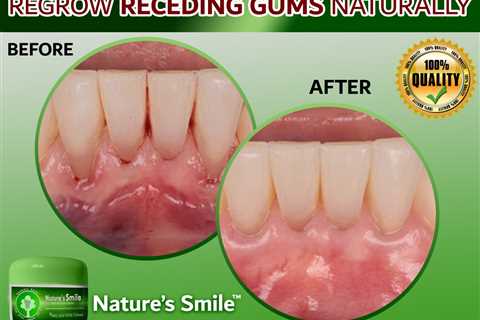 Natures Smile and Gum Recession