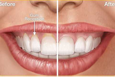 what does gum recession look like