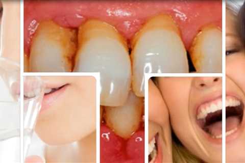 How Can You Reverse Receding Gums Without Surgery?