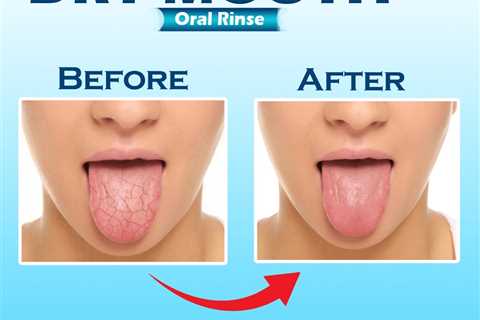What is the best product for dry mouth