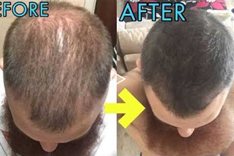 CRAZY MICRO-NEEDLING BEFORE/AFTER RESULTS FOR HAIR REGROWTH!