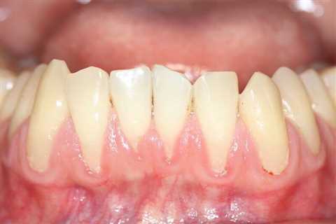 Can I Reverse Receding Gums?