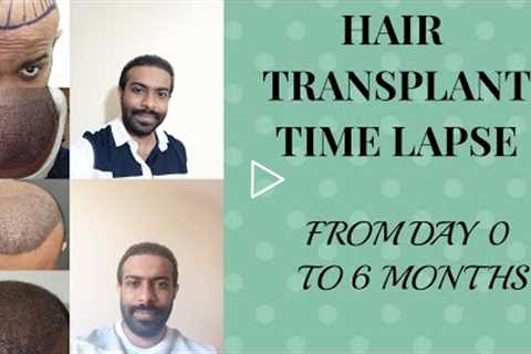 Hair transplant - time lapse Day 0 to 6 months