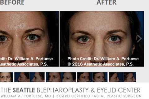 The Seattle Eyelid & Blepharoplasty Center