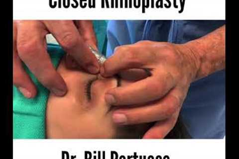 Closed Rhinoplasty by Dr William Portuese