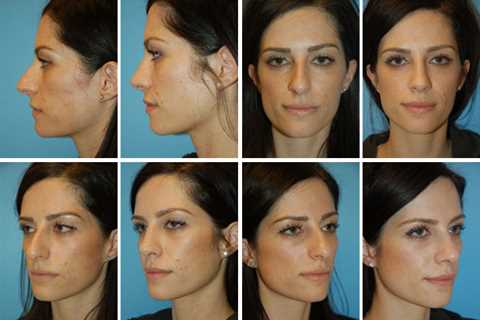 Virtual Rhinoplasty Tool - Face Touch Up - Nose Job Simulator