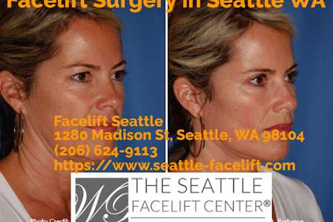 Facelift Seattle