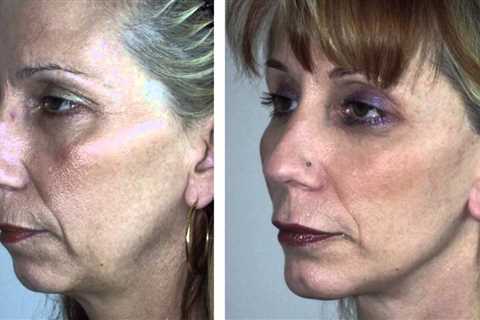 Combining a Facelift with Chin Implant - Facial Rejuvenation