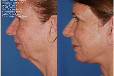 best rhinoplasty surgeon in washington state | Facial plastic, Rhinoplasty surgeon, Rhinoplasty