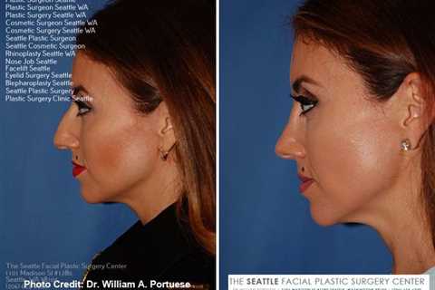 facial seattle | Rinoplasti, Fotoğraf