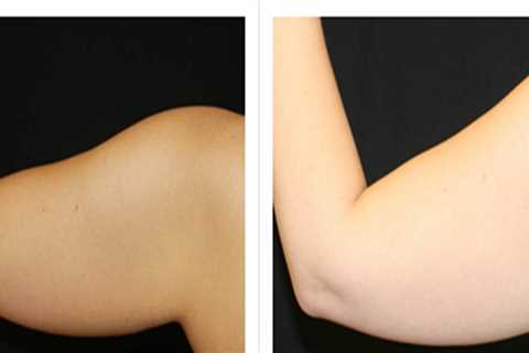What is laser liposuction cost?
