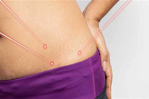 Can laser lipo cause blood clots?