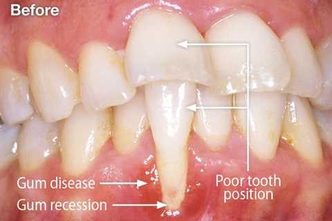 Gum Regrowth Treatment