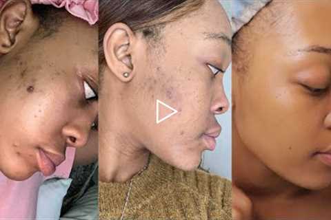 The Skin Care Routine that cleared my acne & hyperpigmentation | OG Parley