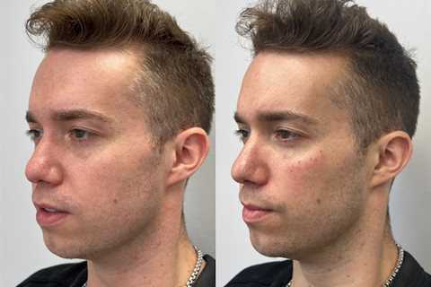 Skin Tightening, Botox and Lip Fillers by Skinsation LA