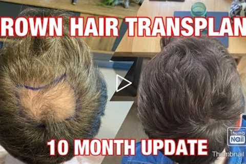 SUCCESSFUL CROWN HAIR TRANSPLANT - FUE surgery in Turkey | Finasteride & Minoxidil - MONTH 10..