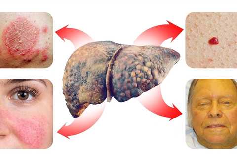 15 SKIN Signs that Reveal Your Liver is a Problem