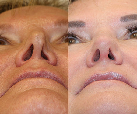 Is It Hard to Breathe Through Your Nose?