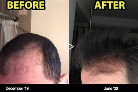 #1 REASON WHY YOU SHOULD BE MICRONEEDLING FOR HAIR LOSS (BEFORE/AFTER PHOTOS)!