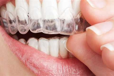 Do aligners fix teeth permanently?