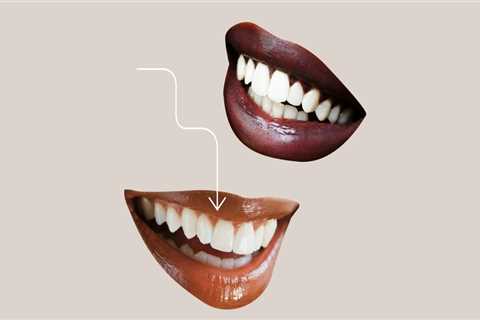 Can you keep veneers forever?