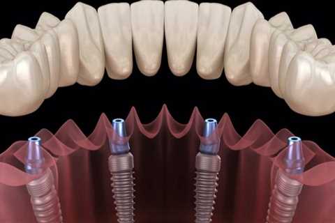 Which is the best type of dental implants?