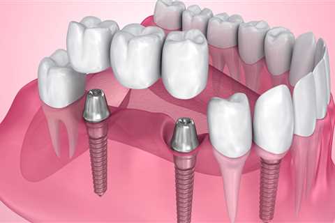Which is a leading cause of dental implant failure?