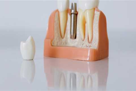 What You Need To Know About Dental Implants In London