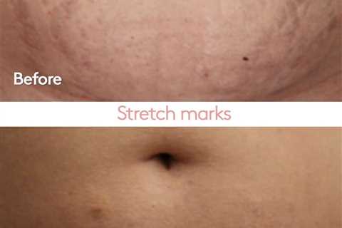 Does Red Light Therapy Work For Stretch Marks?