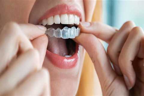 How Much Does it Cost to Get Spark Clear Aligners?