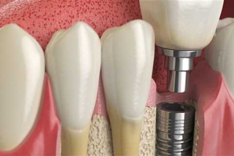 How long does dental implant last?
