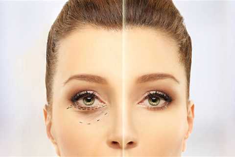 Treating the Lower Eyelids