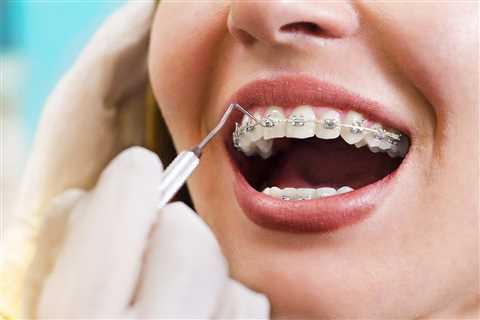 Swollen Gums With Braces - How to Deal With Swollen Gums With Braces? - Natures Smile Balm