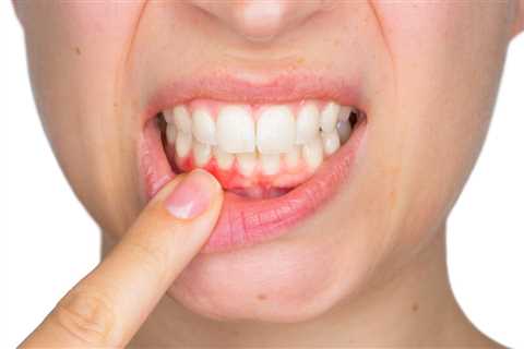 How To Get Receding Gums Grow Back? - Natures Smile Products